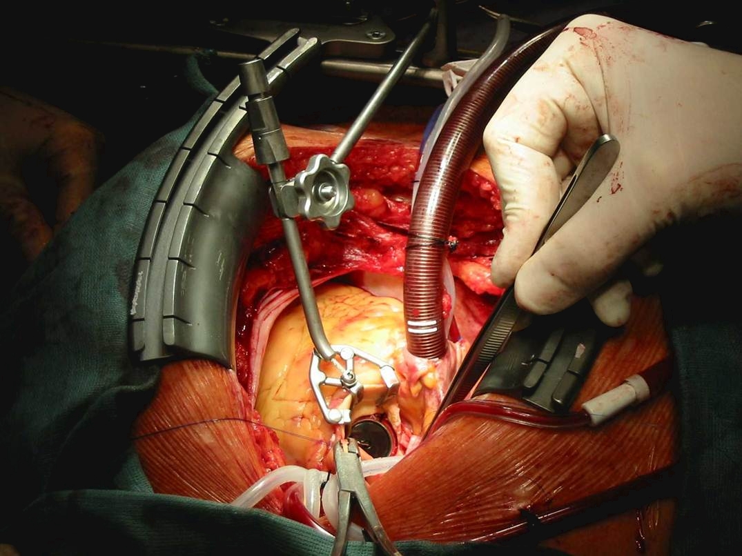 Self Photos / Files - Cor-Valv Surgical Set up - Aortic 1