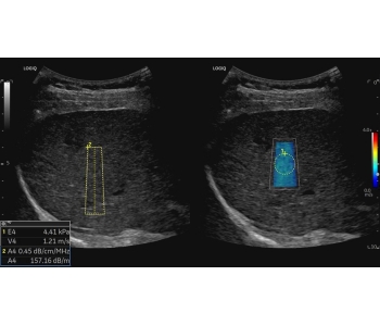 hepatic