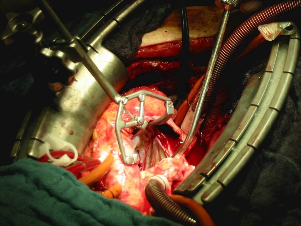 Self Photos / Files - Cor-Valv Surgical Set up - Mitral 2