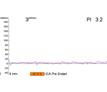 carotid-endarterectomy-pre-and-post-1-e1453288705846