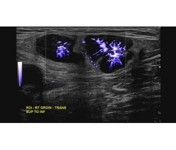 mvi with radiantflow