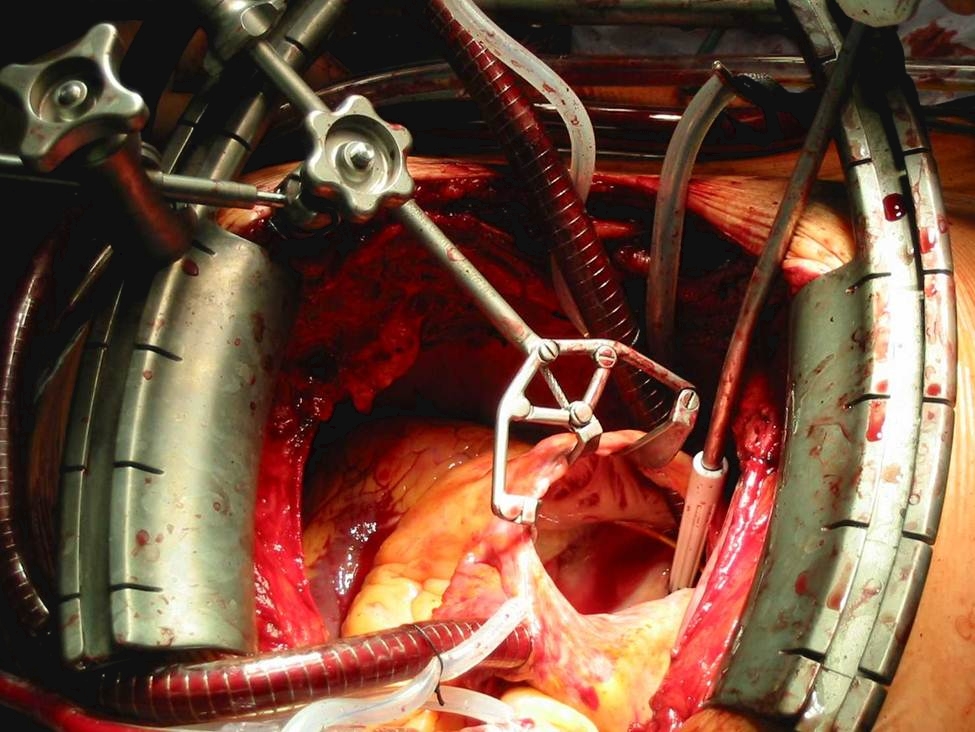 Self Photos / Files - Cor-Valv Surgical Set up - Tricuspid Valve